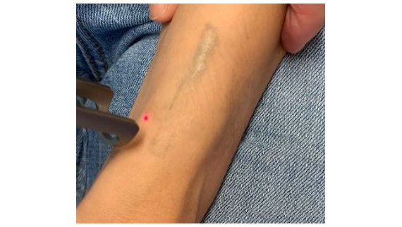 Laser détatouage Q-switched à Toulouse