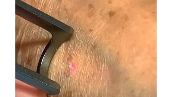 Laser lésions pigmentaires Q-Switched à Toulouse