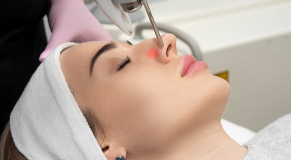 Laser vasculaire ailes du nez. Dermolaser Toulouse