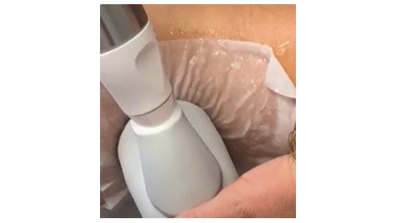 Cryolipolyse à Toulouse