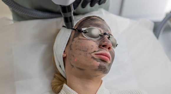 Hollywood peel visage. Dermolaser Toulouse