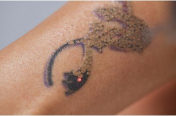 Laser détatouage Q-switched à Toulouse