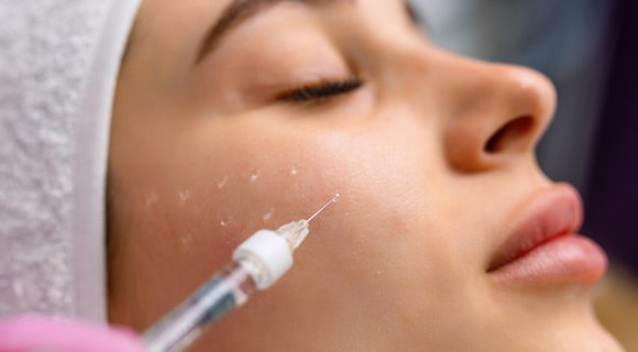 Mésothérapie du visage réalisée au centre Dermolaser à Toulouse