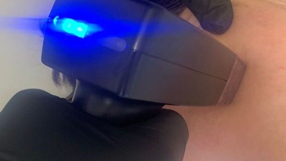 Radiofréquence fractionnée microneedling à Toulouse