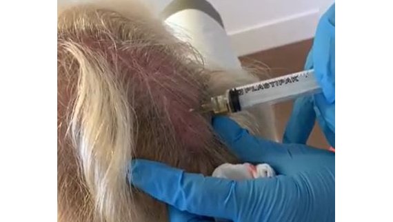 Injections d'A-PRP par méso-needling à Toulouse