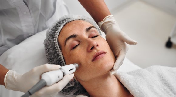 Soin laser pigmentaire visage. Dermolaser Toulouse