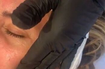 Bio-revitalisation PRX-T33 à Toulouse