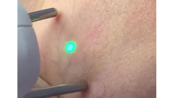 Laser vasculaire Nd-YAG à Toulouse