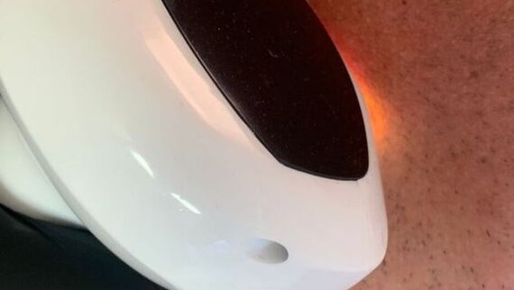 Lumière Pulsée (IPL) à Toulouse