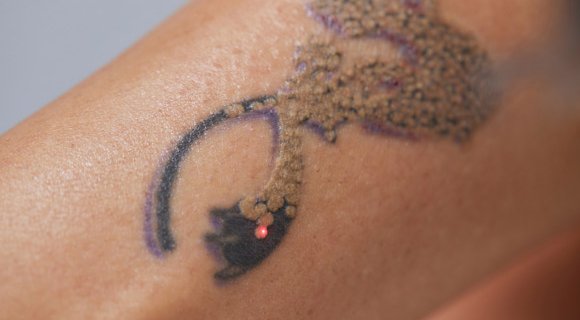 Enlever tatouage au laser. Dermolaser Toulouse