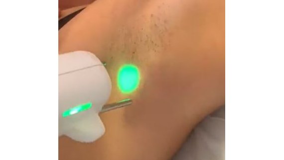 Epilation laser à Toulouse